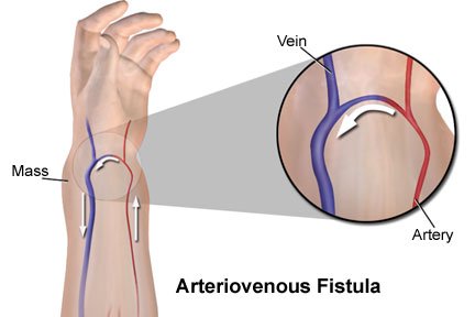 Arteriovenous Fistula Dialysis