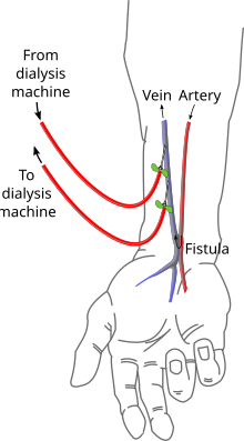 Arteriovenous Fistula Dialysis