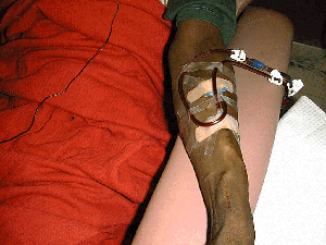 Arteriovenous Fistula Dialysis