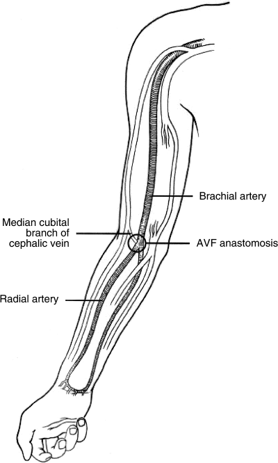 Arteriovenous Fistula Dialysis