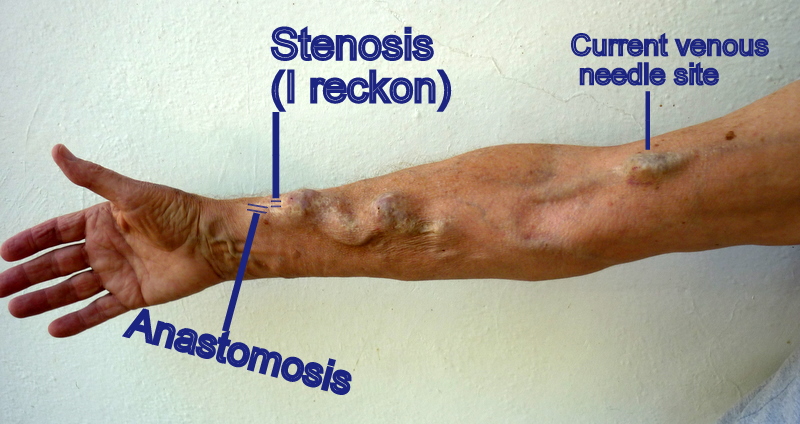 Fistula Dialysis