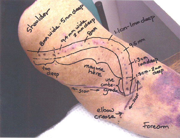 Fistula Dialysis