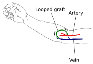 Fistula Dialysis Picture