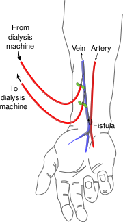 Fistula Dialysis Surgery