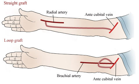 Fistula Dialysis Surgery