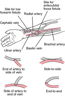 Fistula Dialysis Thrill