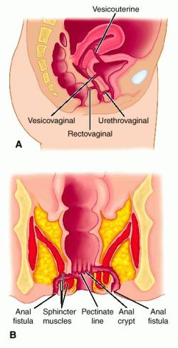 Fistula Dialysis Thrill