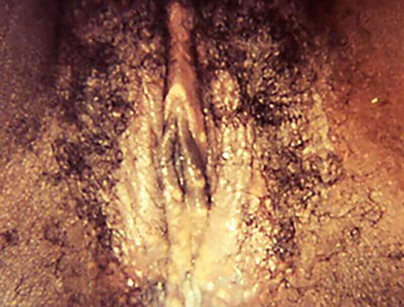 Herpes Pictures Genital