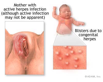 Herpes Pictures Genital