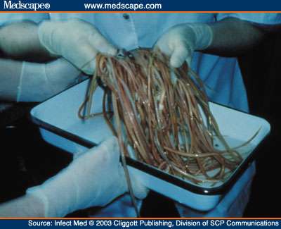 Parasites In Humans Symptoms Pictures