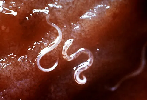 Parasites In Humans Symptoms Pictures