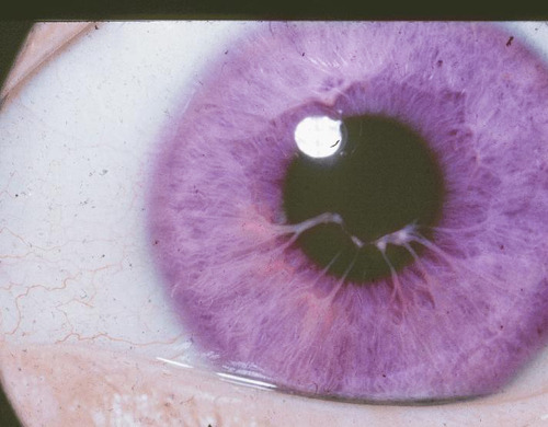 Purple Eyes Disease Tumblr