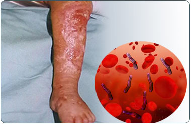 Septicemia Causes