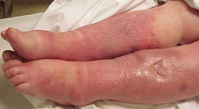 Septicemia Fish Symptoms