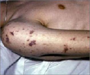 Septicemia Images