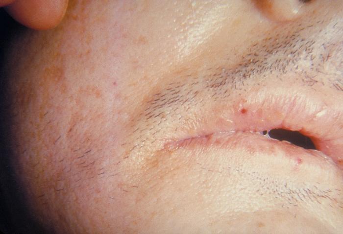 Septicemia Images