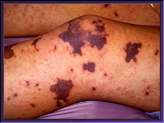 Septicemia Rash