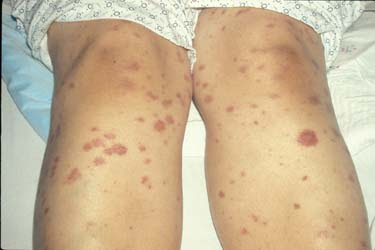Septicemia Rash Pictures