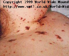 Septicemia Rash Pictures