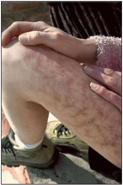 Skin Parasites In Humans Symptoms