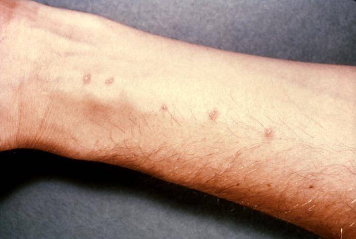 Skin Parasites In Humans Symptoms
