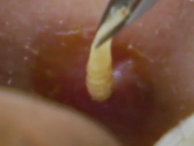 Types Of Skin Parasites In Humans