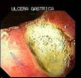 Ulceras Del Estomago