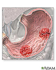 Ulceras Del Estomago