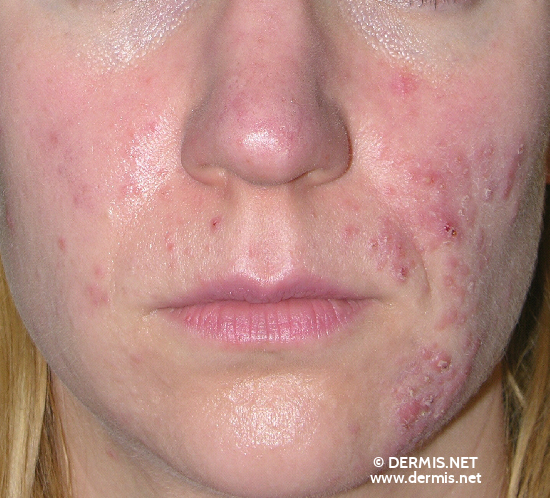 Pyoderma Faciale Rosacea Fulminans