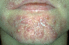 Pyoderma Faciale Rosacea Fulminans
