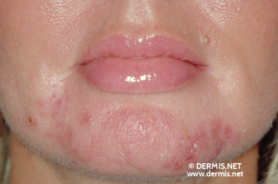 Pyoderma Faciale Rosacea Fulminans