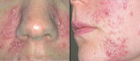 Pyoderma Faciale Rosacea Fulminans