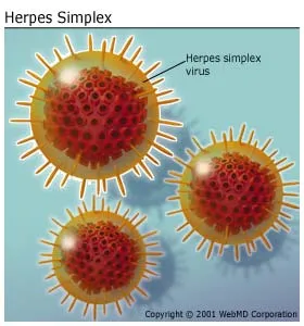 Herpes Simplex 1 Genital Transmission