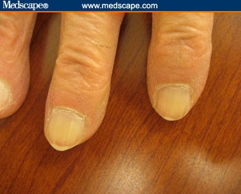 Malignant Melanoma Fingernail