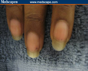 Malignant Melanoma Fingernail